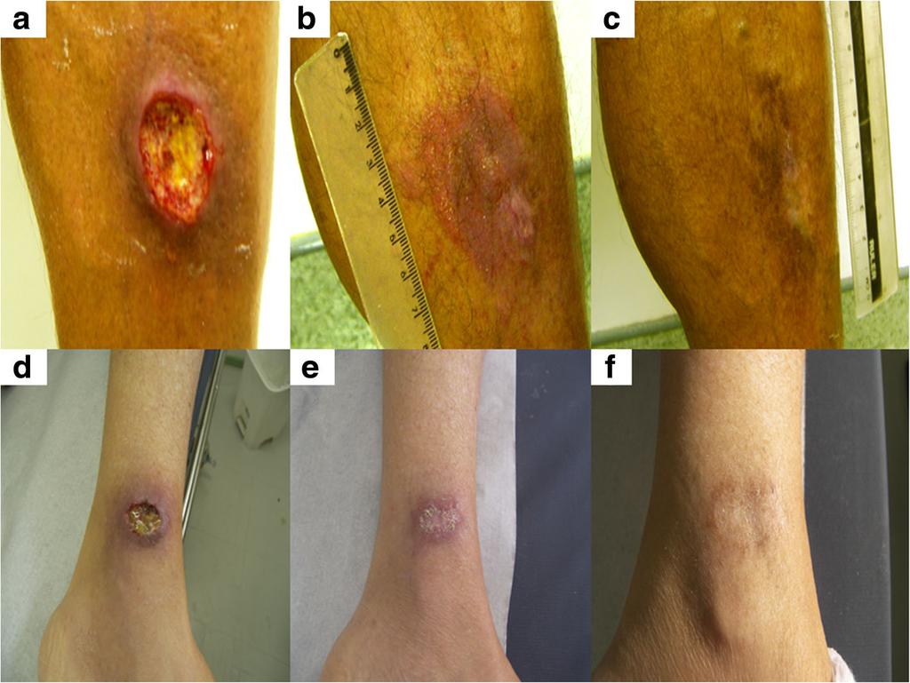 Oliveira-Ribeiro et al. BMC Infectious Diseases (2017) 17:559 Page 3 of 8 Fig. 1 American cutaneous leishmaniasis (ACL), typical skin lesion, non-early spontaneous healing(nesh).