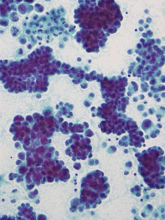 Papillary 3-D clusters that are longer than wider