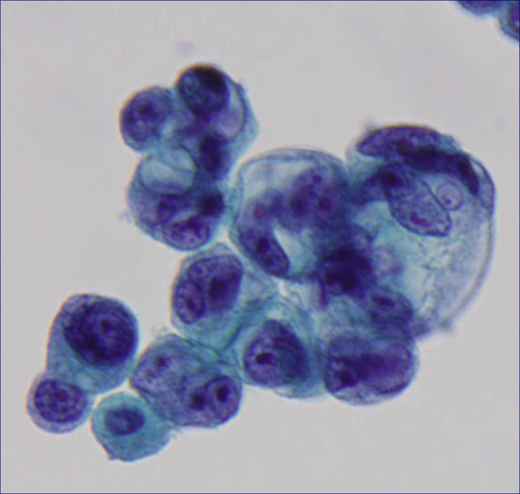 Cytoplasmic Vacuoles Vacuoles without indentation Non-specific, often
