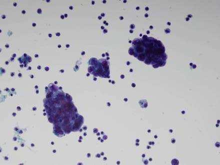 Adenocarcinoma Large clusters or isolated cells Foreign population
