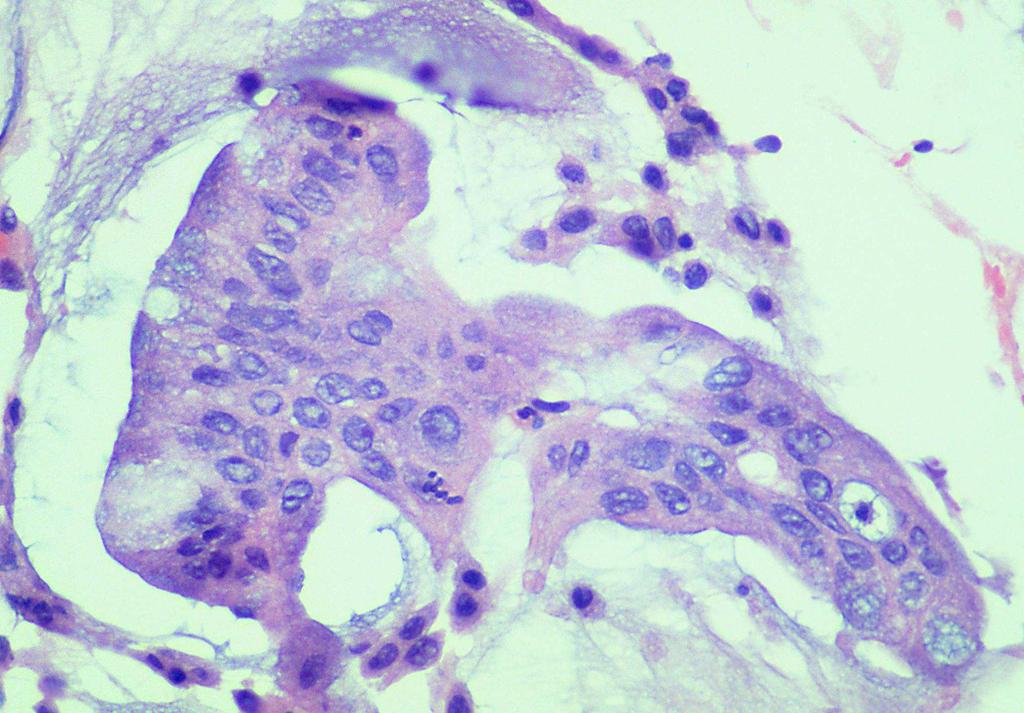 Columnar cells Mucinous tumors,