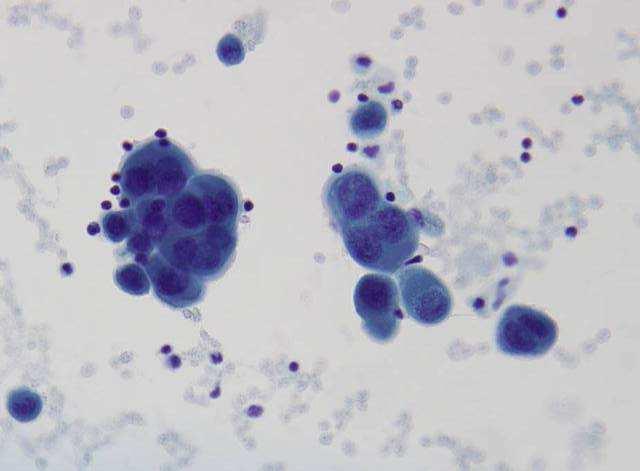 Mesothelial appearance of cells Spectrum: benign atypical