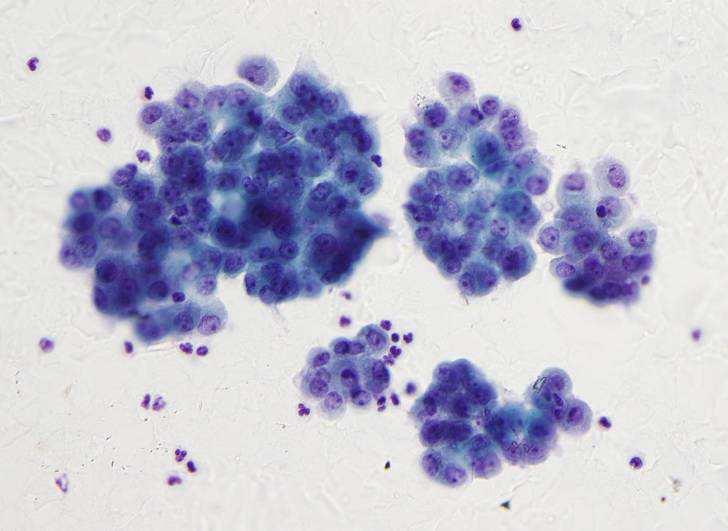 Mesothelioma Subtle atypia- indistinguishable from benign reactive cells Mesothelioma
