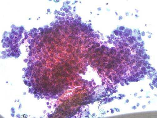 Squamous cell CA < 1% of effusions contain squamous