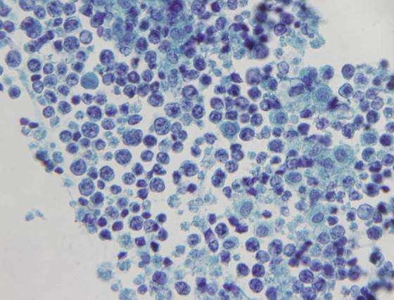 Lymphoma Specific classification seldom needed Most patients have Hx of lymphoma May