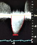 Measure the systolic frame that yields the largest LVOT diameter (normal range 1.8-2.2 cm) proximal and parallel to the plane of the AOV (approximately 0.