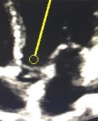 Ideally, acquire the LVOT diameter at the same level as the LVOT PWD measurement (3). NOTE: echo assumes a circular LVOT; however, most are oval.