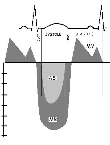 AS: MORE NOTES! a. If the AS results do not make sense, double check all of the measurements particularly the LVOT diameter. TIMING OF MV, MR & AS b.