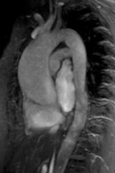 Aortic complications of BAV and implications on