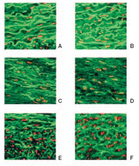 Expression of extracellular matrix proteins in BAV and Marfan aortic aneurysms are similar, but differences are