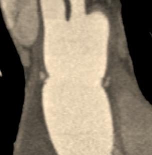 sinotubular junction or sinuses of Valsalva Atherosclerotic origin SUPRACORONARY GRAFT 1. Ascending aortic graft 2. Preservation of native coronary ostia 3.