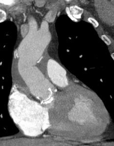 Valsalva With aortic