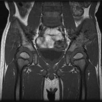 Coronal T1-weighted MR image 550/14 (TR/TE) showing the left pelvic mass has the same