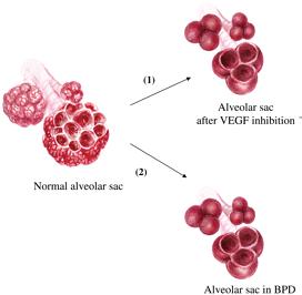 BPD FEATURES Airways: Fewer and simplified alveoli Increased smooth muscle in airways Vasculature: High