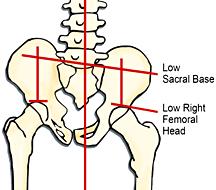 Pelvic Obliquity and Postural Imbalance You must determine