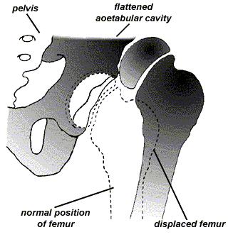 Congenital Hip Dysplasia Flattened acetabular cavity