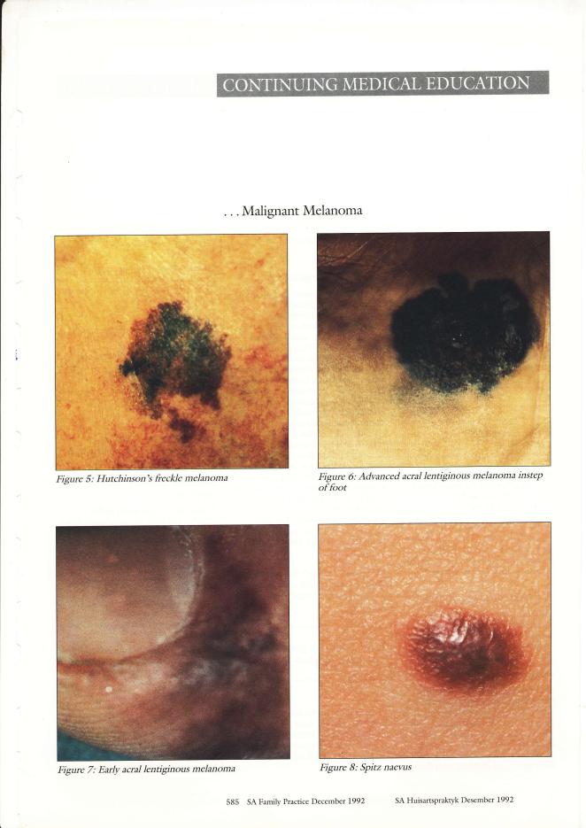 ...MalignantMelanoma Figure 5: Hutchinson's freckle melanoma Figure 6: Advanced acral lentiginous melanoma instep of foot