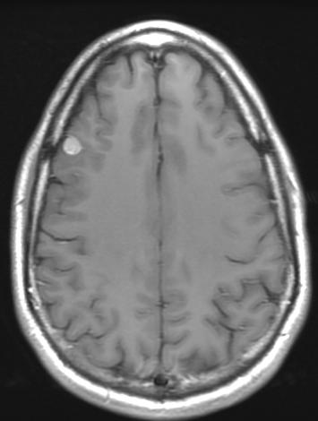 Our Patient: Frontal Lobe nodule There is an approximately 1 cm enhancing mass within the right frontal lobe, which