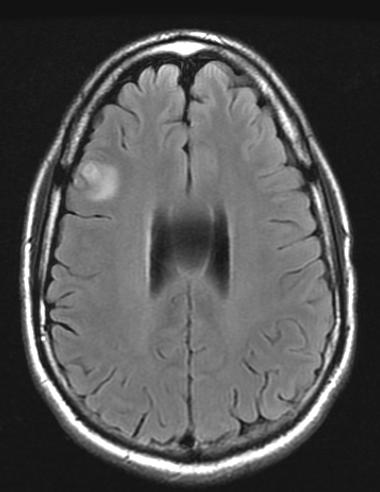 Our Patient: Frontal Lobe nodule There is surrounding vasogenic edema within the right frontal