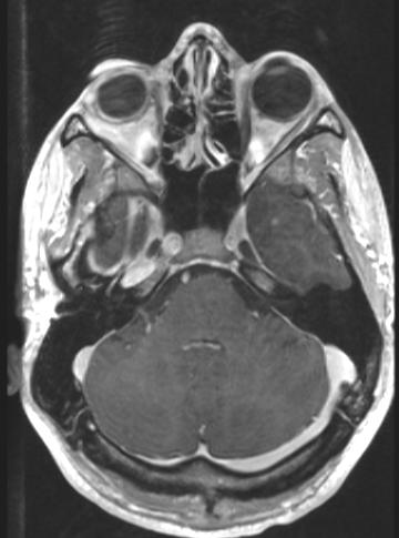 Our Patient: Temporal Lobe nodule Within the inferior left temporal lobe there is an enhancing lesion