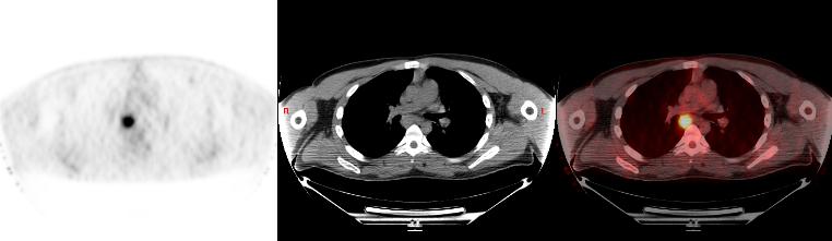 Our Patient: Subcarinal lymph node conglomerate PACS, BIDMC Axial, FDG, Chest PET Axial, C, CT Axial, FDG, Chest PET Axial, FDG, Chest CT CHEST: A 2.
