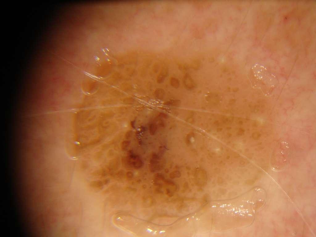 Similar features to last image, comedo like openings, milia like cysts and stuck on border.
