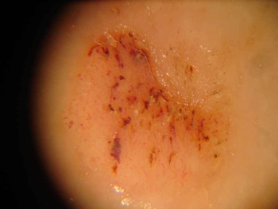 Note blood in crypts, also poorly focussed looped vessels, and