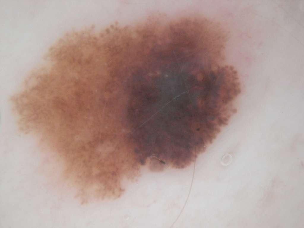 Note peripheral globules between 2 and 6 o