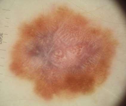 melanoma Ugly duckling +++ Muktiple colours including blue, white, brown Shiny white structures