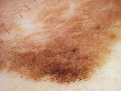 melanoma Part of a very large lesion (see graticule) Multiple colours and patterns
