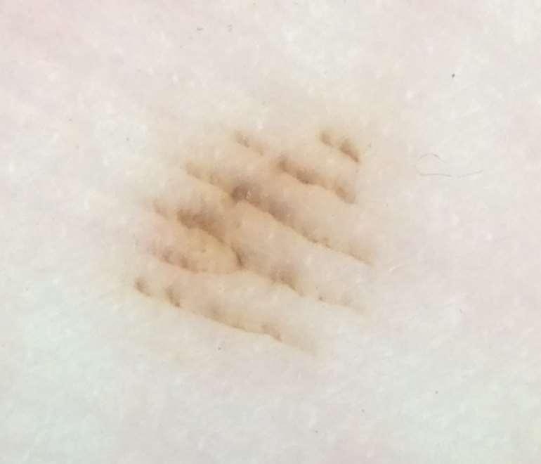 The tiny pale dots mark the RIDGES, therefore the pigment is mainly in the FURROWS which is a benign pattern.