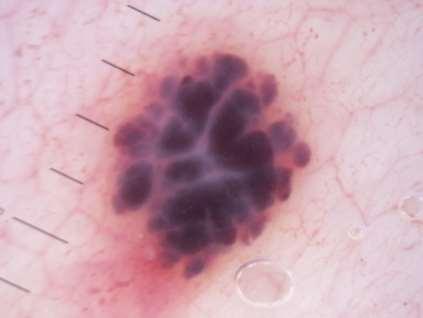 Haemangiomas= blood in fibrous stroma Blood is allowed to be blue, red, purple/mauve or black (if