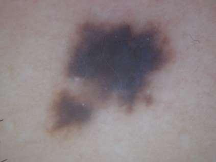 Benign, spindle cell naevus with epithelioid features You will NEVER get down to a ratio of 1 melanoma per suspicious pigmented lesion excised, and