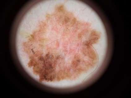 melanoma ABCD fail Multiple colours and patterns including shiny white streaks, network, eccentric blotch,