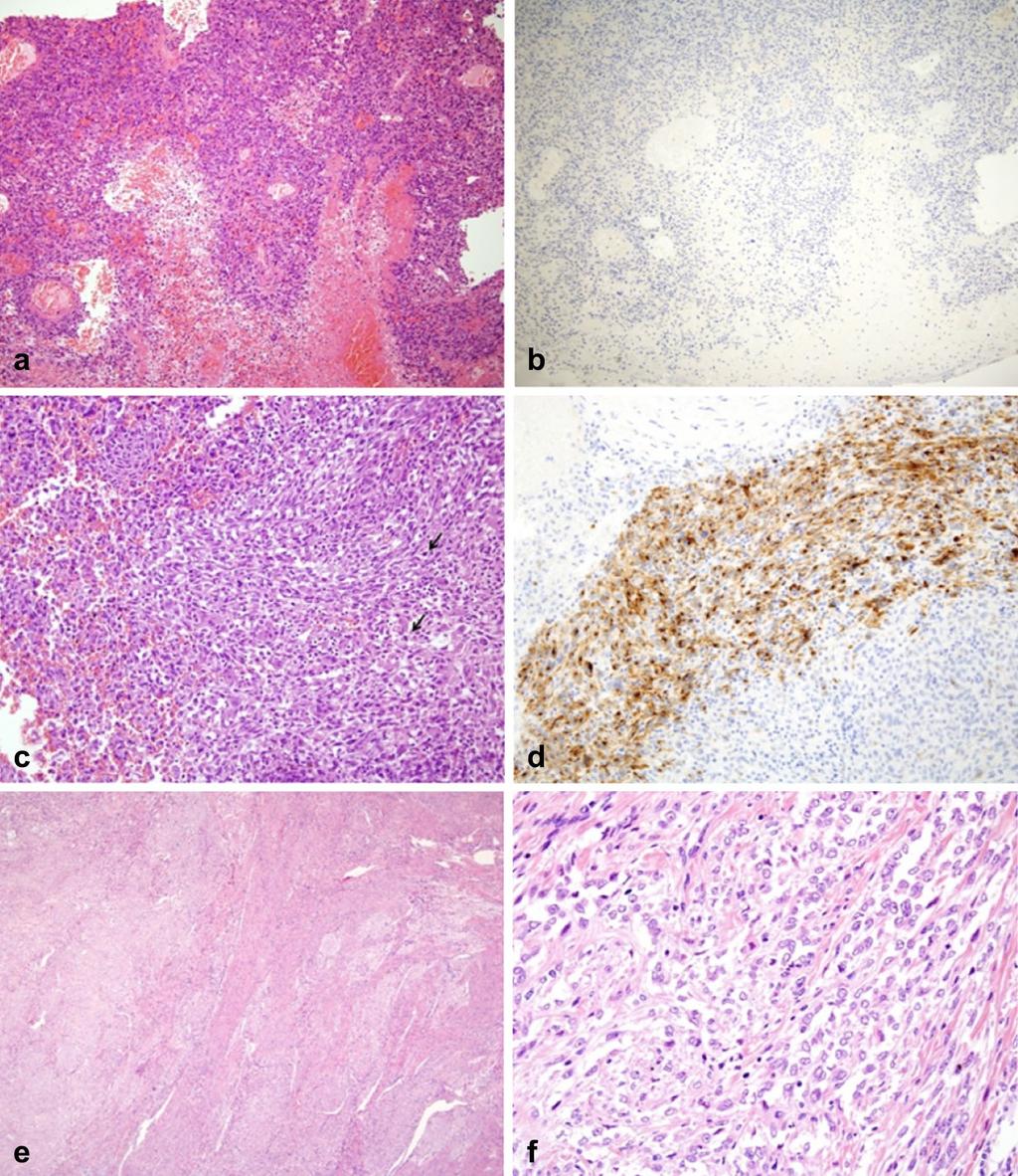 Page 2 of 6 mass was performed. Histologic and immunohistochemical findings (positive for SMA, but negative for HMB45) were malignant tumor, suggestive of leiomyosarcoma (Fig. 1a, b).