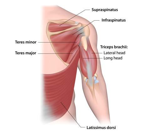 Mumford arthroscopic procedure resects the distal clavicle in cases of posttraumatic degenerative disease of the AC joint and shoulder impingement syndrome.