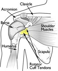 Rotator Cuff Tears A rotator cuff tear is a common cause of pain and disability among adults. A torn rotator cuff will weaken your shoulder.