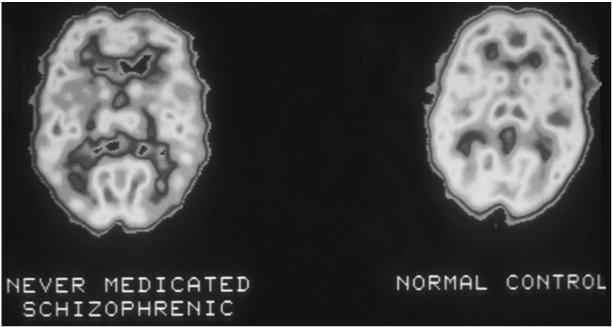 Causes of Schizophrenia (cont'd) Biologic Theory: Brain Structure Abnormality Differs from those with no symptoms May be genetically based Requires more study Figure 16-2 PET scans measuring regional