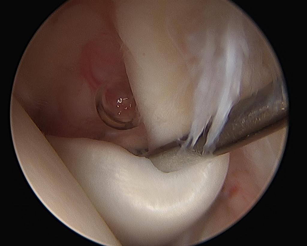 Diagnostic Arthroscopy Pulling the long head of the