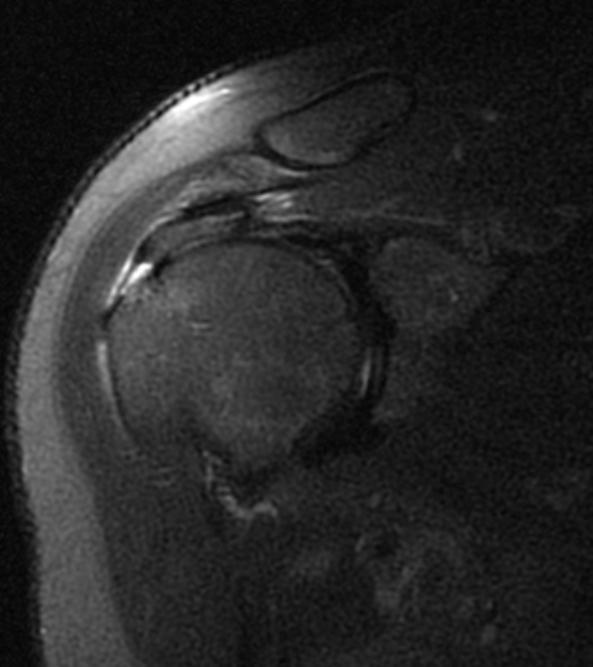 KY is a patient with a bursal sided, high grade partial rotator cuff tear on preoperative MRI This