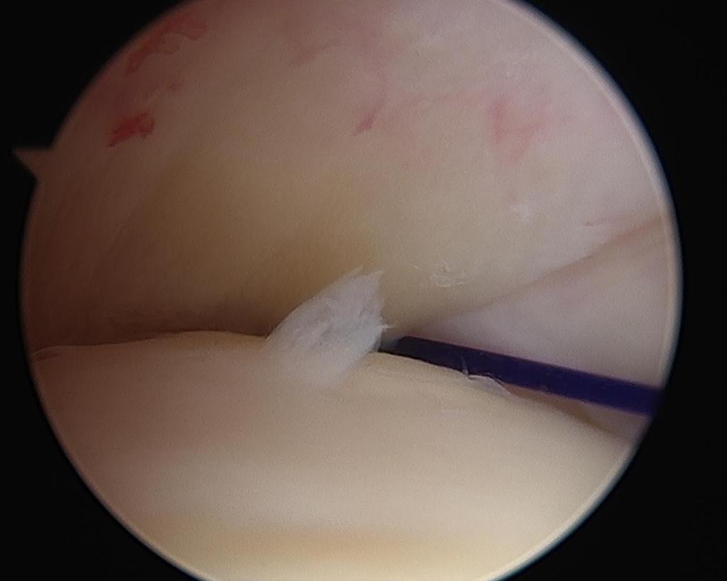 Rotator cuff tendon Patient KY Biceps The rotator cuff appears normal when viewing from the joint.