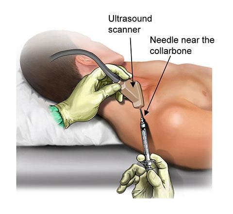 Preoperative Nerve Block The nerve block consists of an injection of anesthetic pain medicine around the nerves that innervate the arm This is commonly done with