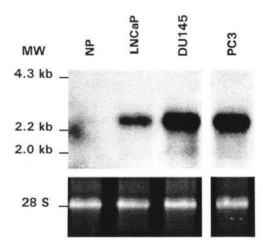 18 FDG-PET GLUT1 expression: lower in the well-differentiated; hormone-sensitive LNCaP cell line.