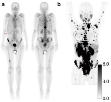 68 Ga-PSMA & Bone Mets Bone Scan vs PSMA PET diagnostic performance PSMA outperformed BS: detection of more bone lesions in initial staging and BCR.