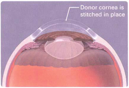DALK is commonly used to treat keratoconus or bulging of the cornea. Healing time after DALK is shorter than after a full cornea transplant. There is also less risk of having the new cornea rejected.