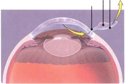 Endothelium Descemet's membrane Diseased tissue is removed through small incision What to expect when you have a corneal transplant Days or weeks before your transplant.
