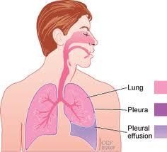 Shortness of breath Lungs Pleural effusion fluid in