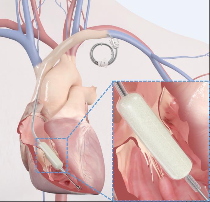 FORMA Tricuspid Valve Therapy System (Edwards Lifesciences) Spacer Rail Positioned within regurgitant orifice Provides surface for native