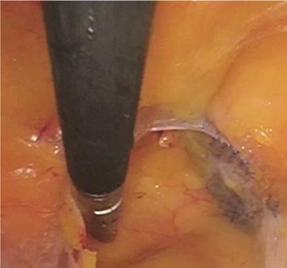 Case Reports in Urology 3 andreduceriskofinjury.thevesicoperitonealreflection was identified and the peritoneum was incised 3 cm above the border extending between the obliterated umbilical ligaments.