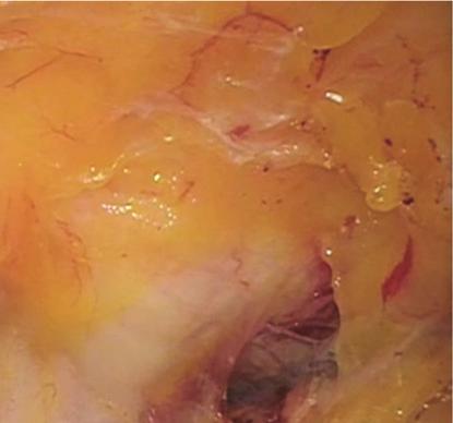 The bladder was then drained and blunt dissection was continued down into the retropubic space until reaching the pubocervical fascia.